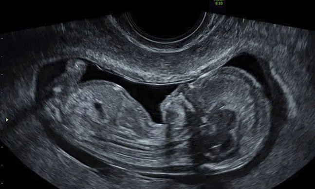 Ultrassonografia Obstétrica